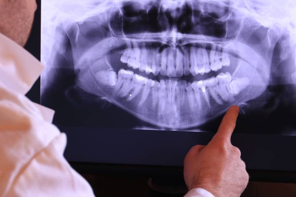 Best Emergency Wisdom Tooth Extraction in Westview, FL